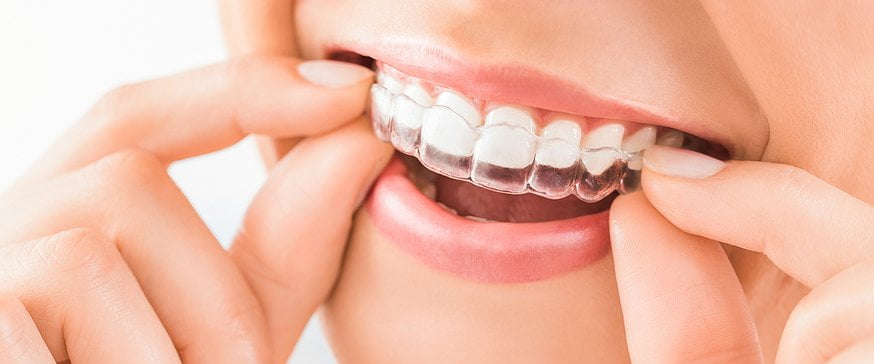 Invisalign Tray