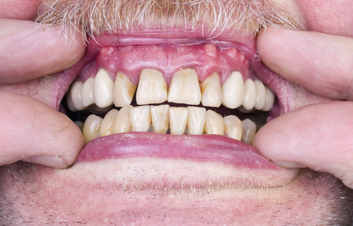 Other Causes of Toothaches Besides Cavities