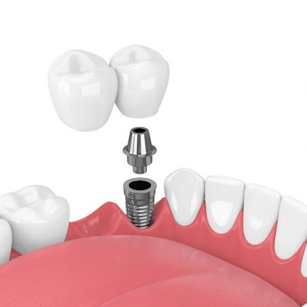 Dental Bridge in Brampton